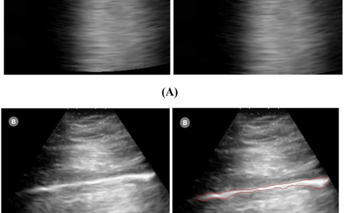   A new study examines novel technologies for COVID-19 diagnosis using ultrasound.  - Watts up with that?

