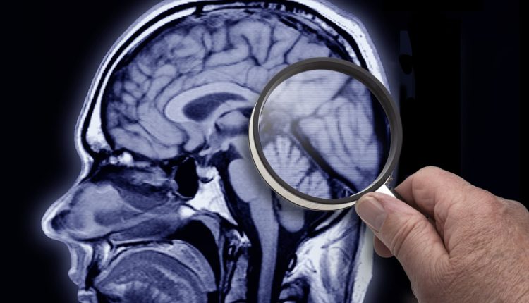 Medicare details plan to cover Alzheimer's treatments

